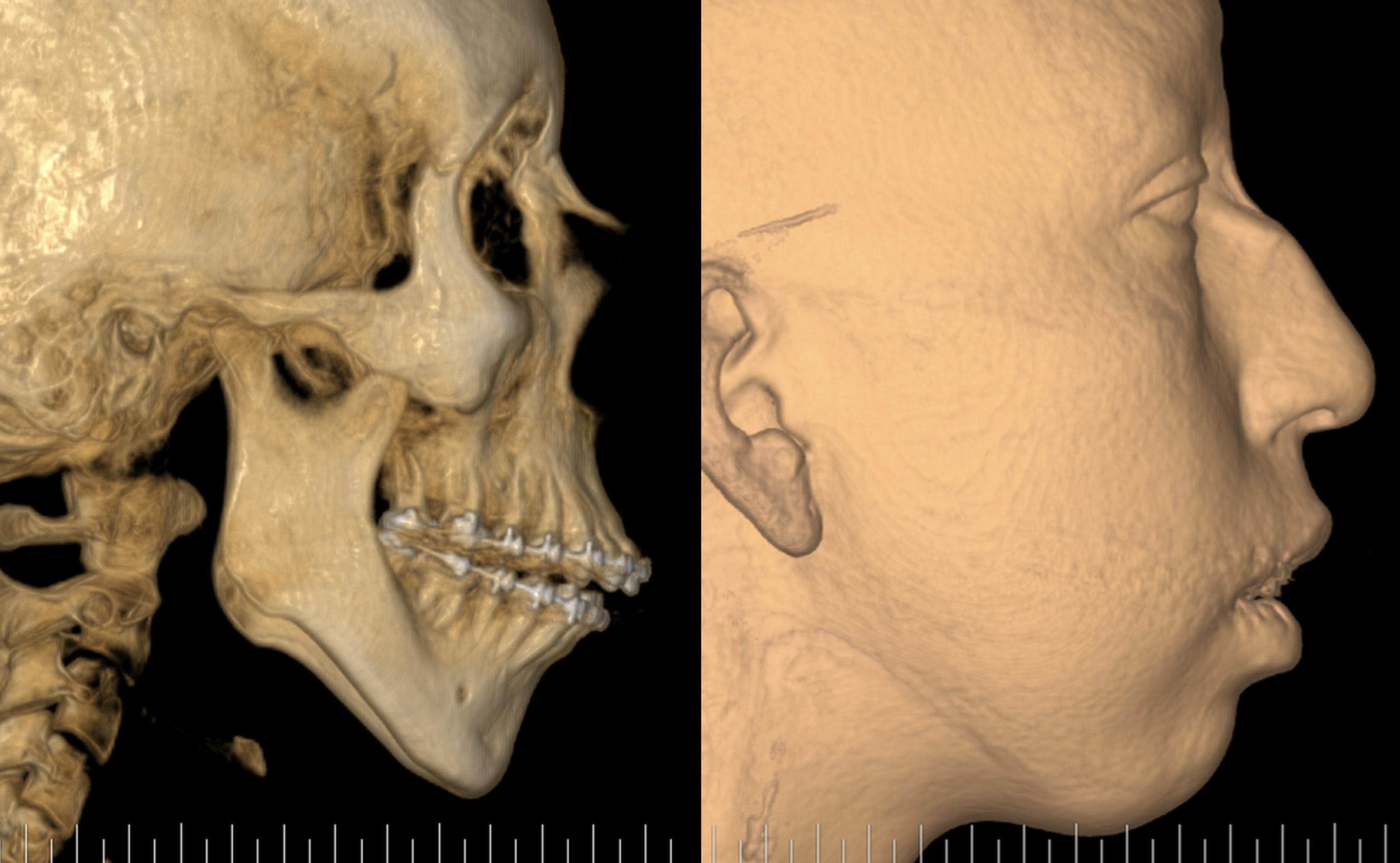 Cirugía Ortognática y Ortofacial – A New Face